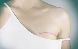 Chuyên gia tiết lộ cách trị sẹo do phẫu thuật ngực