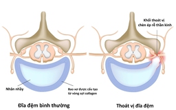 Điều trị thoát vị đĩa đệm theo các giai đoạn của bệnh