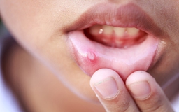 Hiểu đúng về nhiệt miệng và cách điều trị