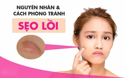 Top 9 kem trị sẹo lồi lâu năm hiệu quả được mua nhiều