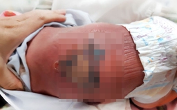 Cho 2 mẹ con hơ than sưởi ấm, con bị bỏng, nhiễm trùng máu nặng