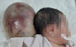 Bệnh viện Nhi đồng 1 cắt bỏ khối u khổng lồ ở đầu trẻ sơ sinh
