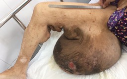 Bệnh nhân có khối u khổng lồ bám vào mông và chân như tổ ong vò vẽ