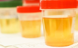 Uống nước tiểu để trị bệnh: Đầy rủi ro và nguy hiểm