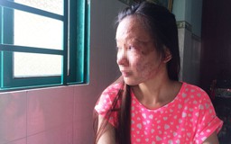 Nữ sinh viên bị tạt axit: Nỗi đau ở lại mãi mãi trên khuôn mặt