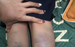 Đà Nẵng: Học sinh lớp 1 đi học về bị bầm tím tay chân do bạn đánh
