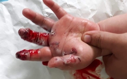 Hai trẻ bị dập nát bàn tay vì pháo nổ