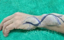 Phẫu thuật khối dị dạng mạch máu vùng cẳng, bàn tay cho người phụ nữ