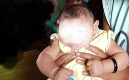 Bộ Y tế xác nhận bé gái bị dị tật đầu nhỏ do vi rút Zika