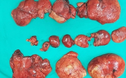 Bóc thành công 20 khối u mỡ trong bụng một bệnh nhân