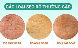 Tổng hợp các phương pháp trị sẹo rỗ hiện nay