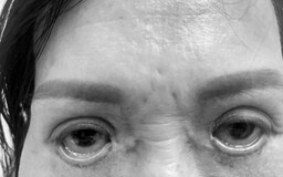 Thẩm mỹ ‘chui’ hoành hành: Một phụ nữ bị trợn ngược mắt sau cắt mí tại spa