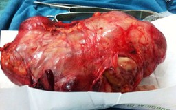 Cắt khối u thận 'khủng' 2,9 kg ra khỏi bệnh nhân