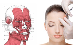 Tiêm Botox có ảnh hưởng thần kinh, làm cho mặt bị 'đơ', căng cứng?