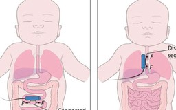 Cấy 'robot' vào cơ thể để điều trị dị tật teo thực quản bẩm sinh