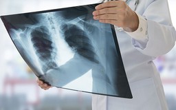10 triệu chứng khác thường của bệnh ung thư phổi
