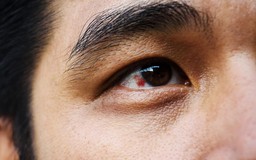 Covid-19 có thể gây hại nghiêm trọng cho mắt