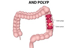 Có cảm giác này khi đi vệ sinh, mau đi khám ung thư ruột