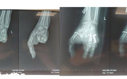 Phẫu thuật chuyển ngón chân thành ngón tay cho bệnh nhân bị máy cuốn nát tay