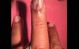 Chàng trai chịu đau đớn vì có 2 móng tay trên 1 ngón tay