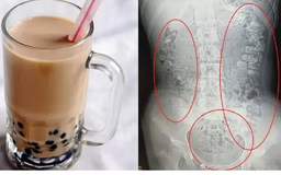 Quá mê trà sữa, cô bé nhập viện vì nghẽn hạt trân châu trong ruột