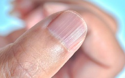 Một phụ nữ Mỹ bị nhiễm vi khuẩn 'ăn thịt người' khi làm móng tay