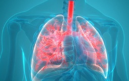 Viêm phổi, viêm phế quản có phải là bệnh dễ lây?