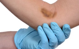 Bị bầm tím sau khi lấy máu hay tiêm vắc xin có sao không?