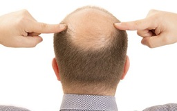 Loại thuốc mới giúp người rụng tóc mọc đến 80% tóc