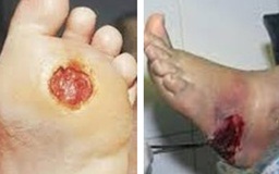 Phương pháp nào điều trị bệnh tiểu đường hiệu quả?