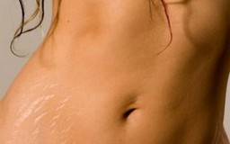 Bụng, đùi, mông bị rạn da do mang thai nên điều trị bằng cách nào?