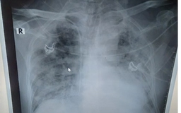 Chụp cắt lớp vi tính chẩn đoán viêm phổi do Covid-19