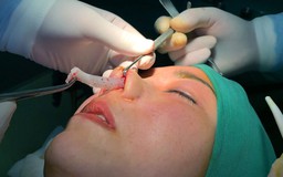 Thẩm mỹ 'chui' hoành hành: Tự tử vì thẩm mỹ mũi bị biến dạng