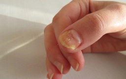 Ngày mới với tin tức sức khỏe: Chú ý móng tay để phát hiện sớm tiểu đường
