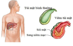 Bệnh sỏi mật và những biến chứng nguy hiểm