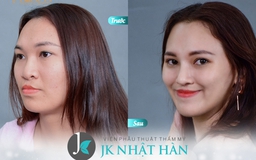 Giải đáp phẫu thuật thẩm mỹ mũi cho người sứt môi hở hàm ếch tuổi trưởng thành