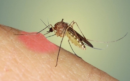 Mách bạn 4 tuyệt chiêu trị sẹo thâm do muỗi đốt nhanh nhất tại nhà