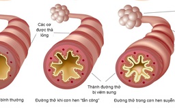 Giải pháp cải thiện ho, khò khè, khó thở