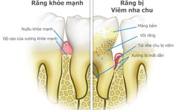 Giải pháp nào cho bệnh nhân viêm nha chu?