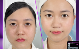 Doctor Beauty giúp Lâm Vỹ Dạ xóa nhăn cấp tốc