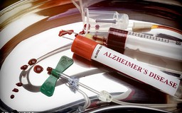 Xét nghiệm máu phát hiện sớm bệnh Alzheimer chính xác đến 98%