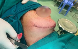 Phẫu thuật thành công ca chấn thương rất nặng vùng hàm mặt