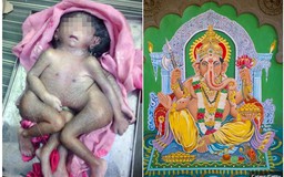Đứa bé có 4 tay, 4 chân được tôn sùng ở Ấn Độ