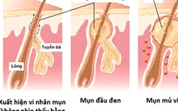 5 cách trị mụn tại nhà đơn giản mà hiệu quả