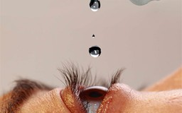 Đột phá trong điều trị cườm mắt