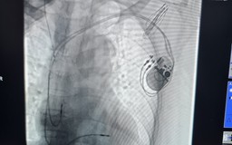 Đặt máy tạo nhịp tim vĩnh viễn cho cụ ông 100 tuổi có nhịp tim 'siêu chậm'