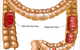 Ung thư đại trực tràng phổ biến nhưng có đáng sợ?