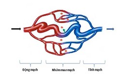 Dị dạng mạch máu não có gây tử vong?