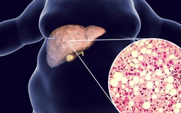 Chớ xem nhẹ bệnh gan nhiễm mỡ vì có thể dẫn đến xơ gan, ung thư gan