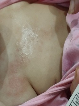 Hàng nghìn người dân tố dùng nước 'sạch' nên bị mẩn ngứa